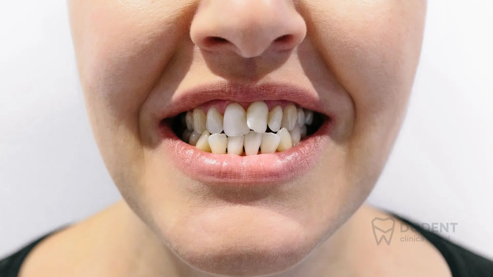 Ortodoncia invisible para dientes apiñados