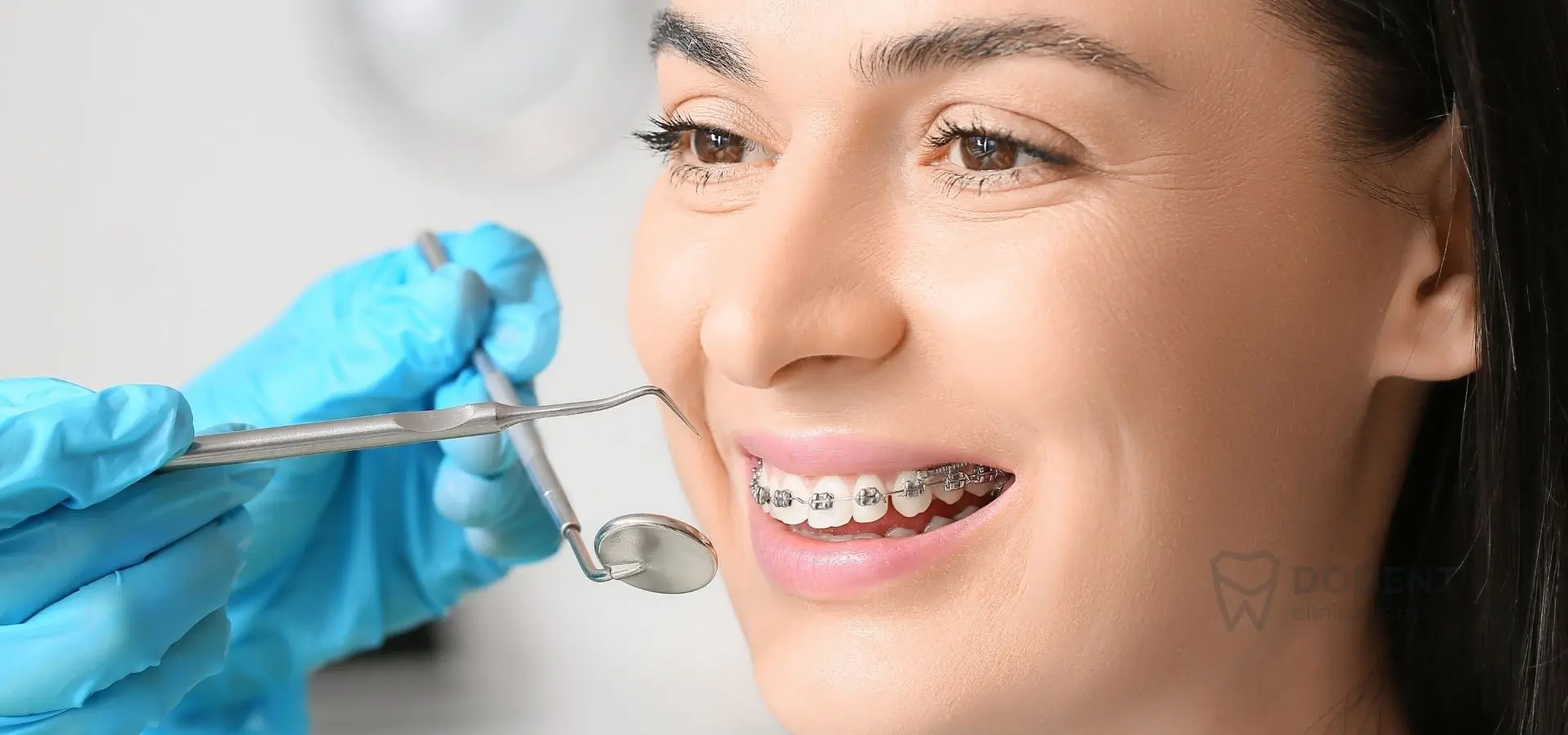 Mordida cruzada en adultos y corrección con ortodoncia